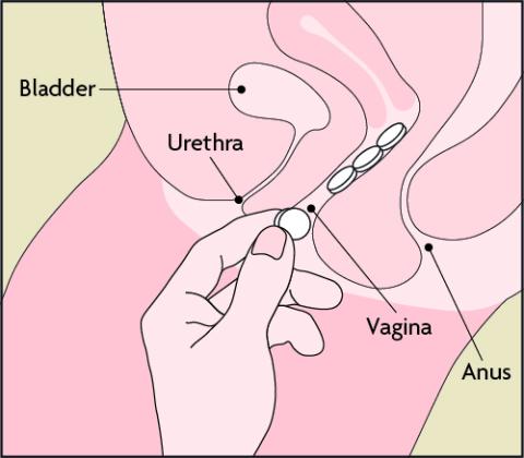 A diagram showing 4 tablets being placed in the vagina