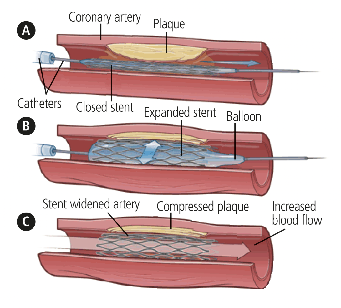 Diagram showing a stent in the artery