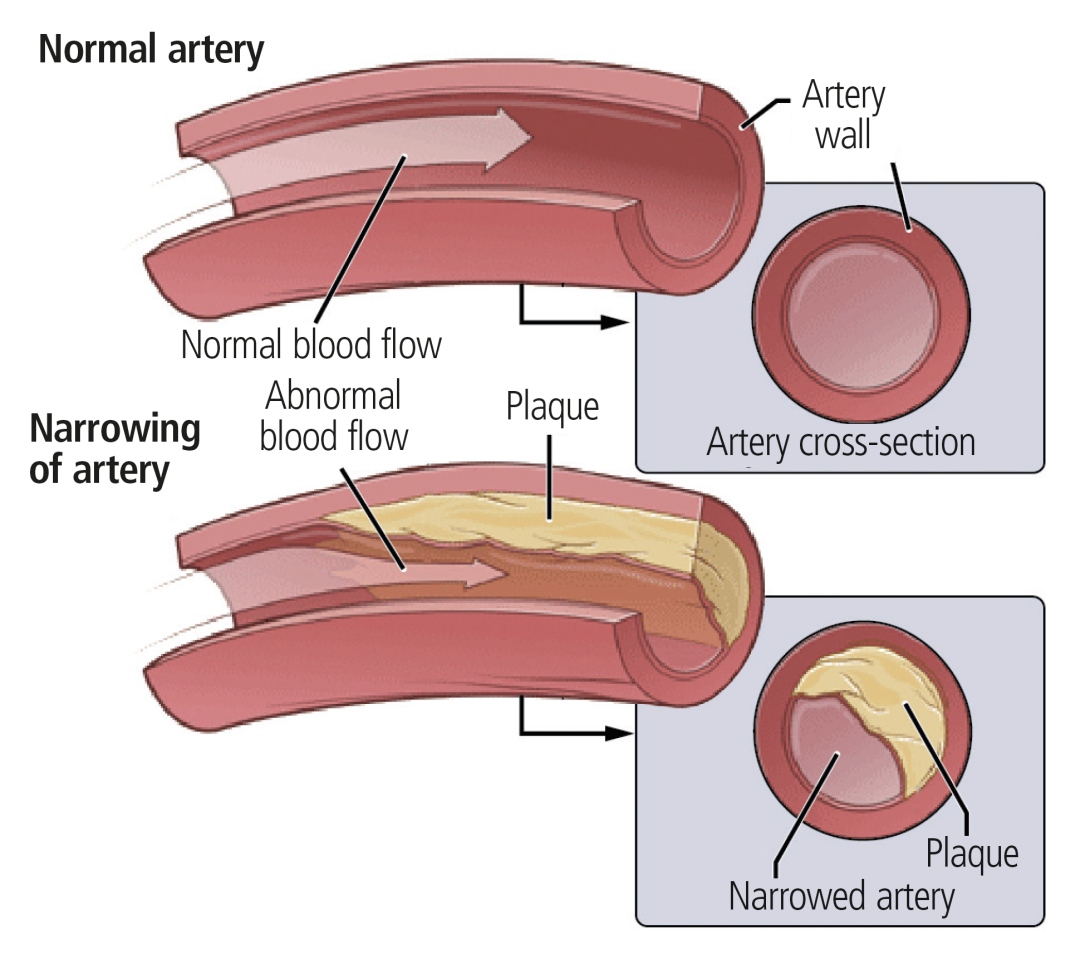 Diagram showing blood flow through a normal artery and through a narrowed artery