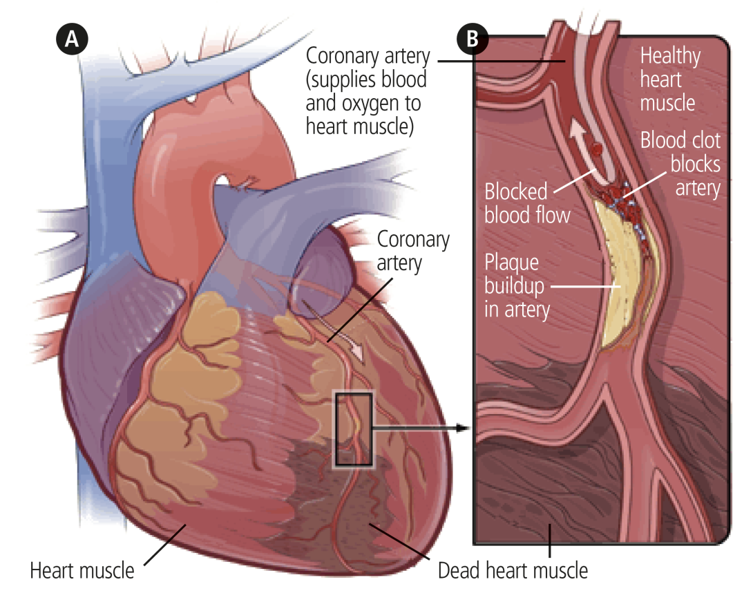 Diagram of the heart and coronary artery