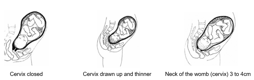 Three diagrams. The first shows the cervix closed, the second shows the cervix drawn up and thinner, the third shows the cervix at 3 to 4cm.