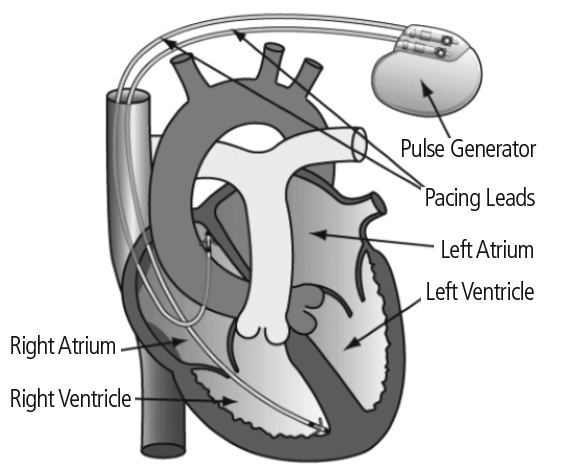 Diagram showing a heart with a pacemaker