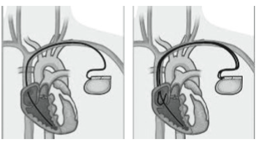 Diagram of single and dual chamber pacemakers