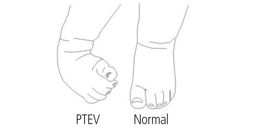 Diagram showing the difference between an ankle with PTEV and a normal ankle