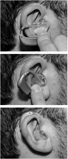 An ear with a mould fit hearing aid