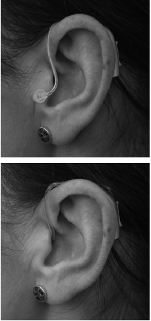 An ear with an open fit hearing aid